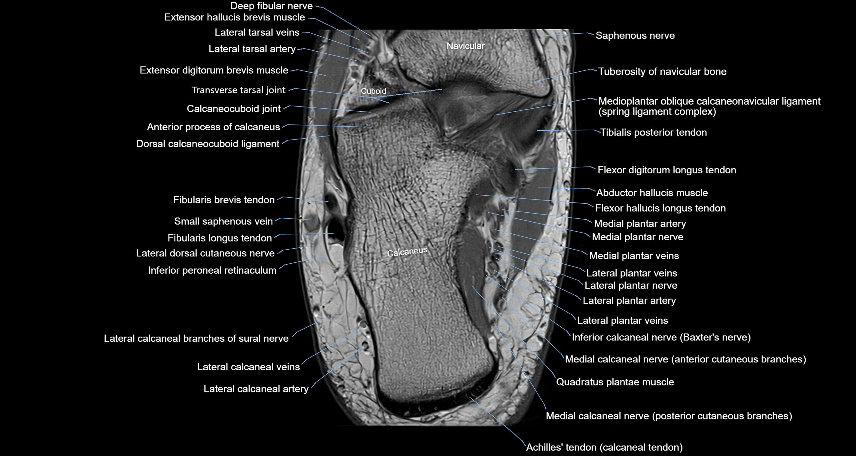 Ankle axial anatomy 3T MRI images -img-10001-00028.webp